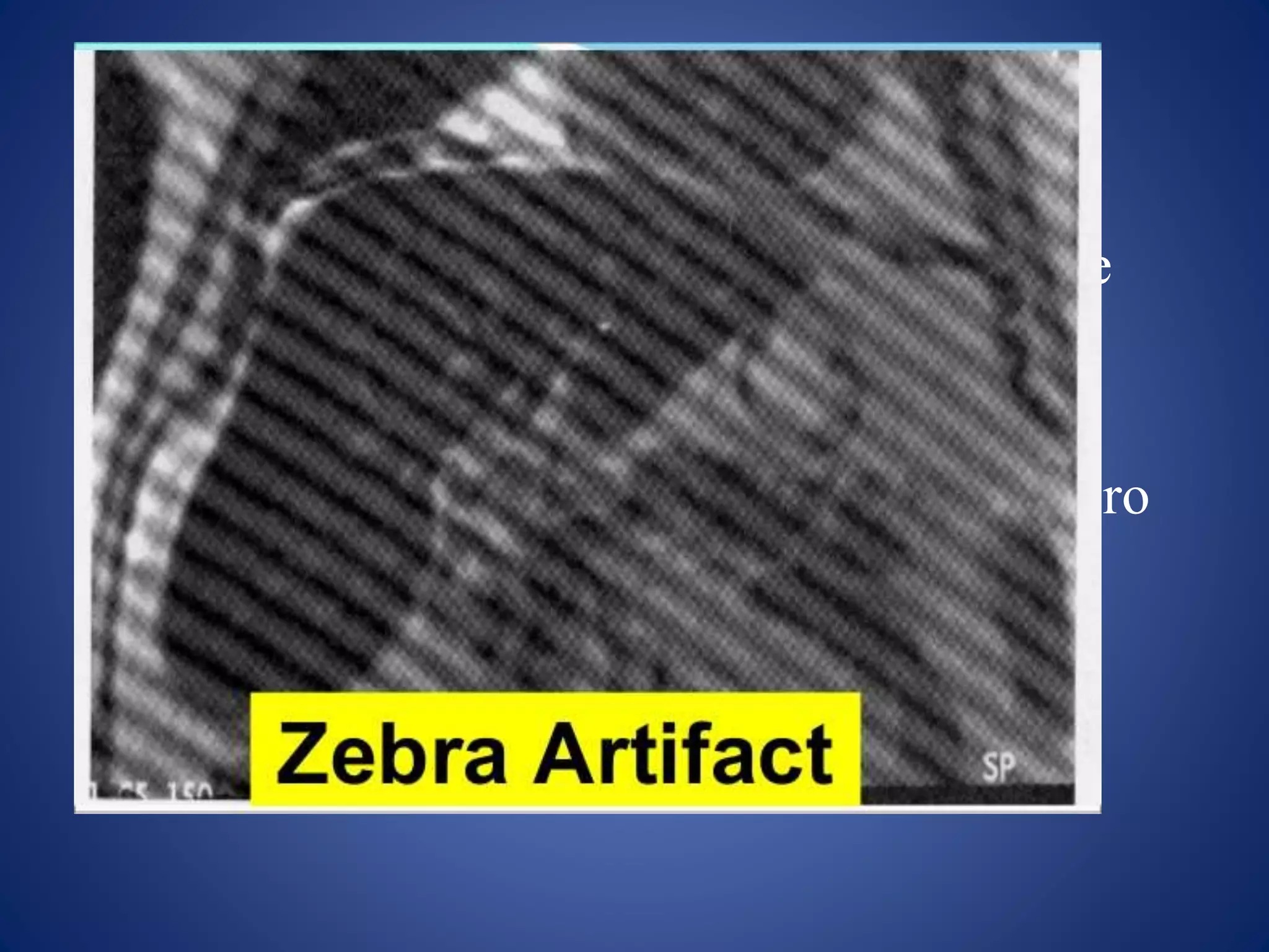 4.Zebra artifact
• Appearance: appears as the black and white
stripes of zebra on the image obliquely
• Causes:
Data is missing in k space array or set to zero
during scanning
Abrupt change in signal from signal to no
signal
 