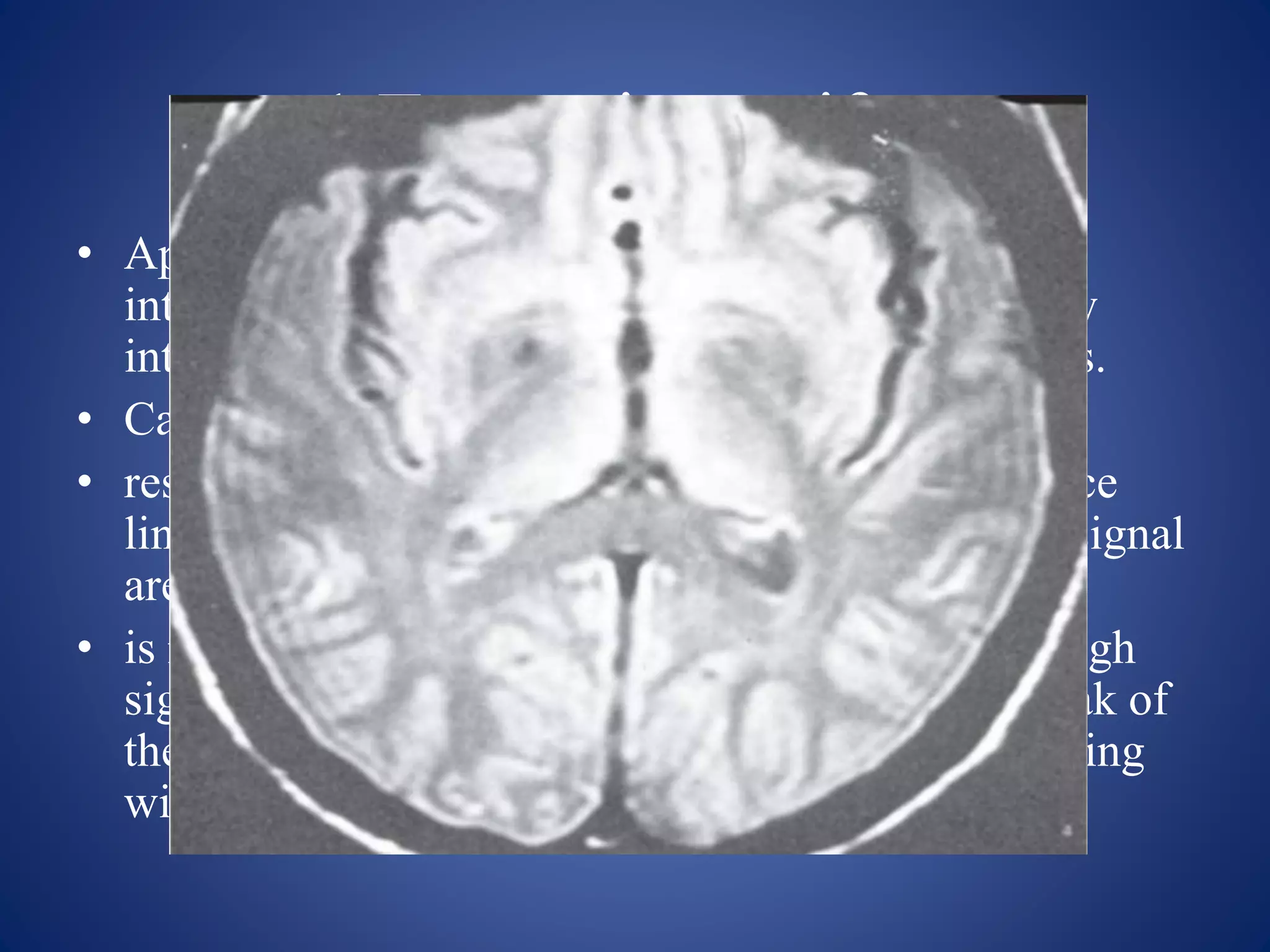 1.Truncation artifact
• Appearance: appears as a banding artifact at the
interface of high and low signals. It creates the low
intensity band running through high intensity areas.
• Causes:
• results from undersampling of data (too few k-space
lines are filled) so that interfaces of high and low signal
are incorrectly represented on the image.
• is most common when tissue is still producing a high
signal at the end of data collection or when the peak of
the echo is not centered in the middle of the sampling
window.
 