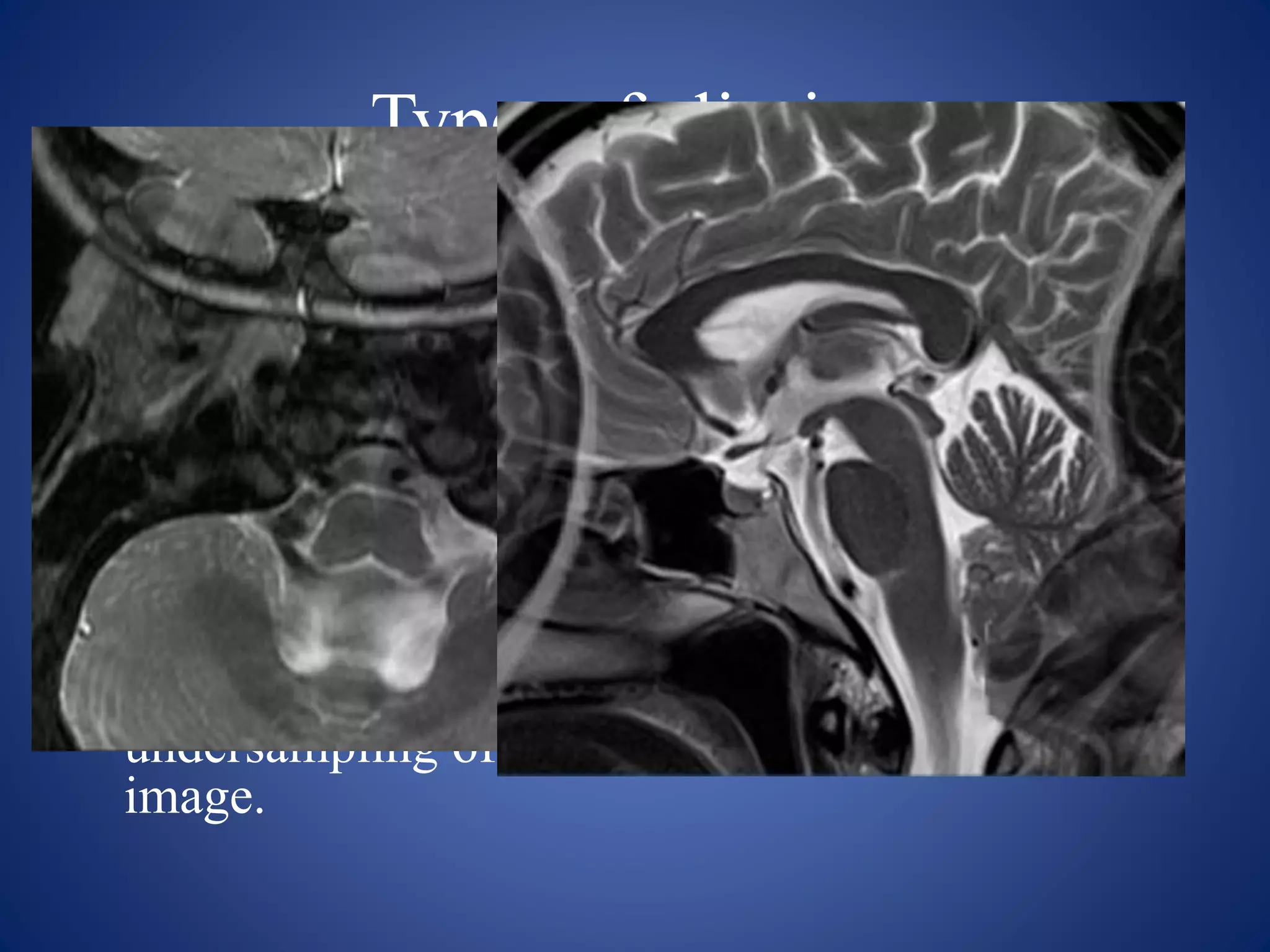Types of aliasing
1. Frequency wrap
• When the FOV is smaller than the anatomy in the
frequency direction of the image, frequencies
outside the FOV are higher than the Nyquist
frequency and are mapped to a lower frequency.
This is called highfrequency aliasing
2.Phase wrap
• Aliasing along the phase axis of the image is
known as phase wrap. This is caused by
undersampling of data along the phase axis of the
image.
 