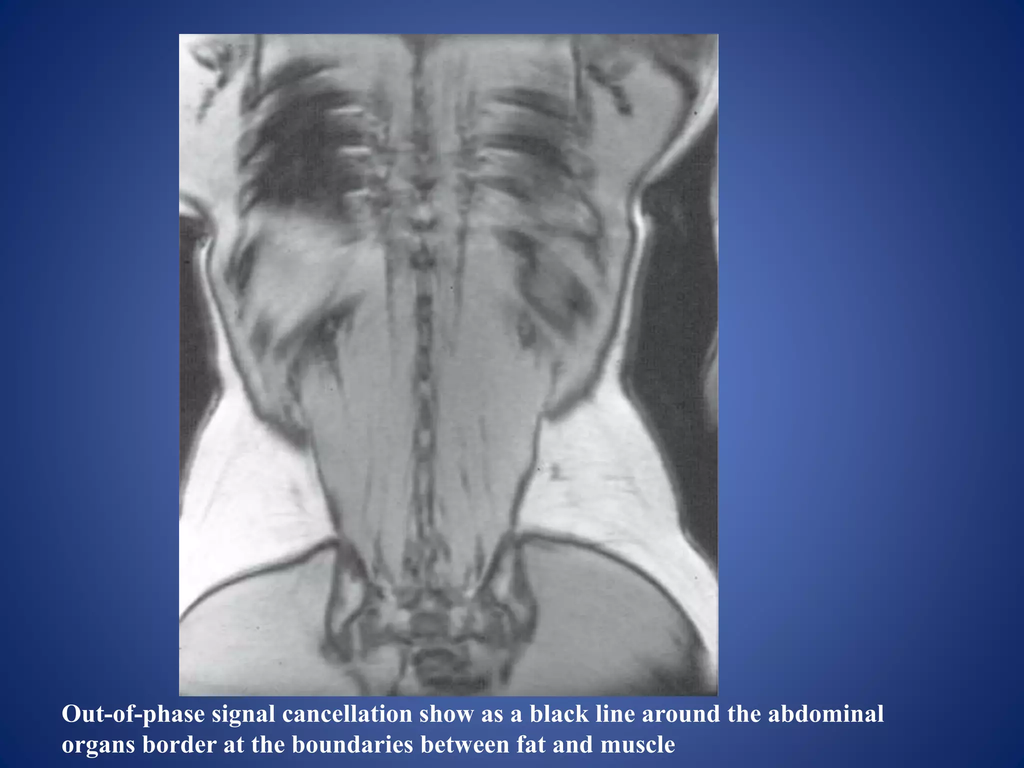Out-of-phase signal cancellation show as a black line around the abdominal
organs border at the boundaries between fat and muscle
 