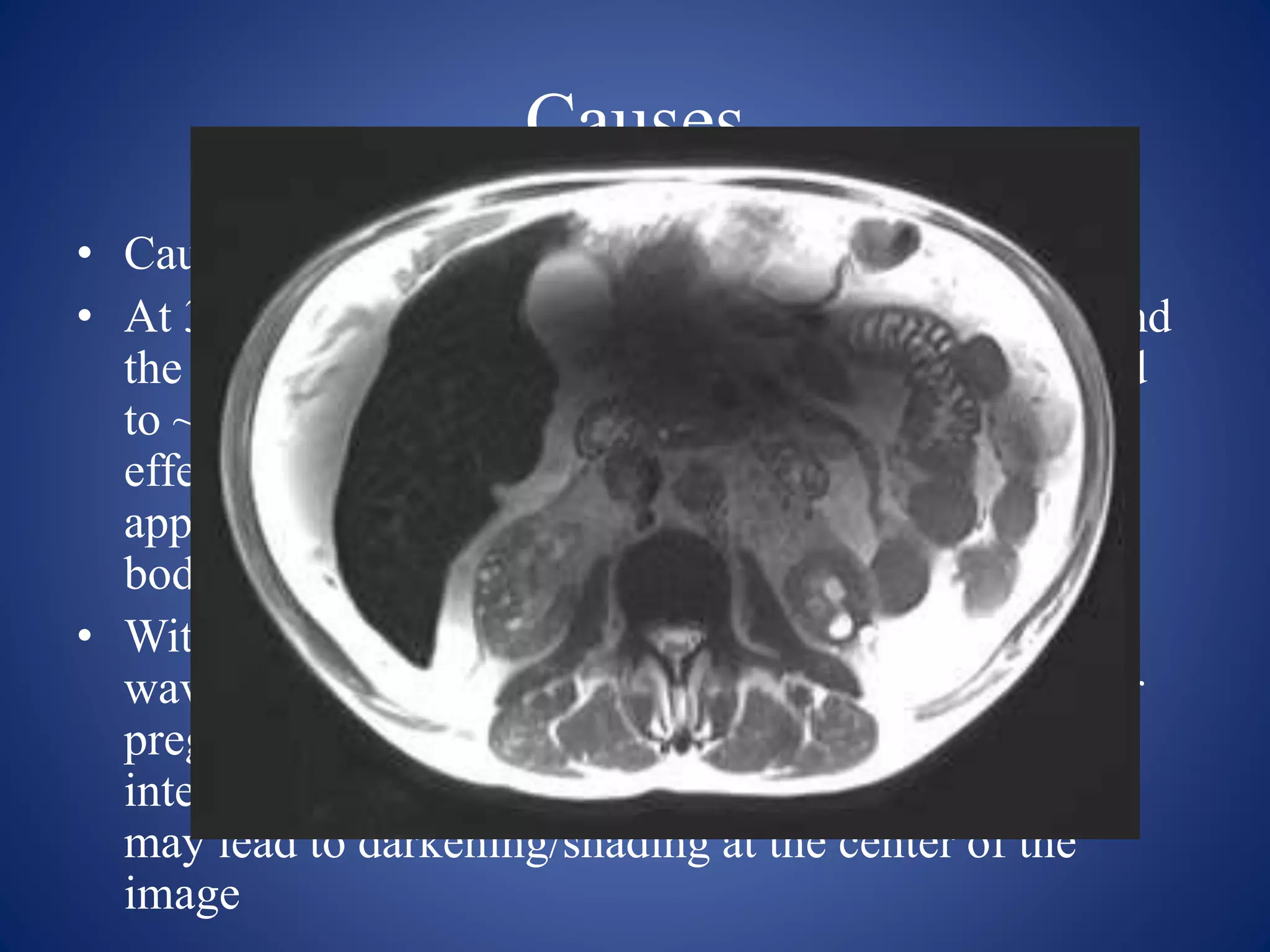 Causes
• Caused by shortening of the RF
• At 3 T, the RF wavelength measures 234 cm in air, and
the speed and wavelength of the RF field is shortened
to ~26 cm within the body as a result of dielectric
effects. However, this 26 cm field of view is
approximately the cross-sectional diameter of most
body imaging studies.
• With patient abdominal diameters that exceed the RF
wavelength (e.g. patients with cirrhosis and ascites or
pregnant patients), constructive and destructive
interference patterns may emerge. In body MRI this
may lead to darkening/shading at the center of the
image
 