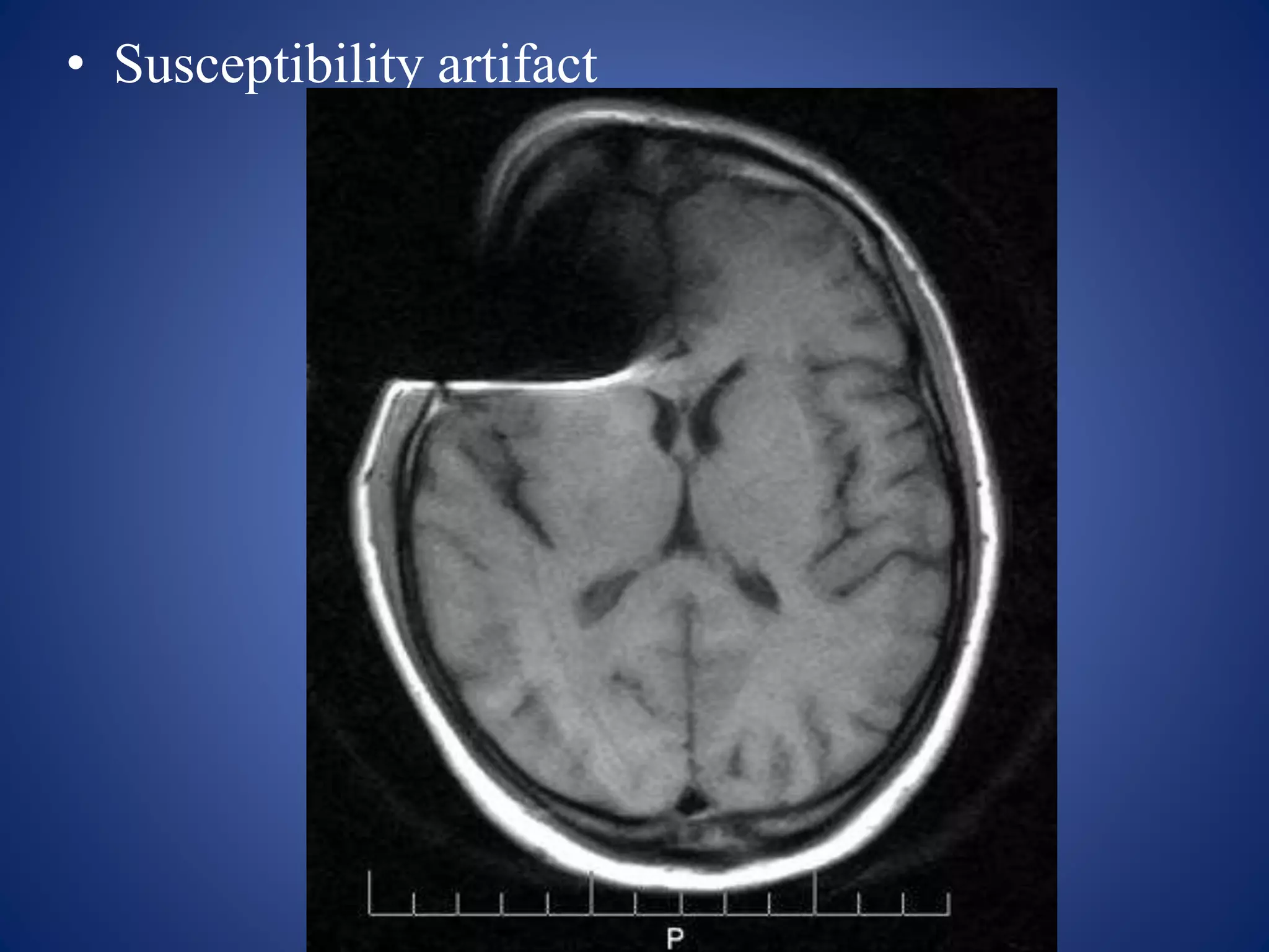 • Susceptibility artifact
 