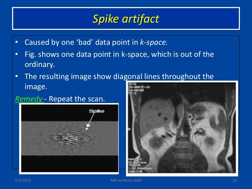 MRI artifacts