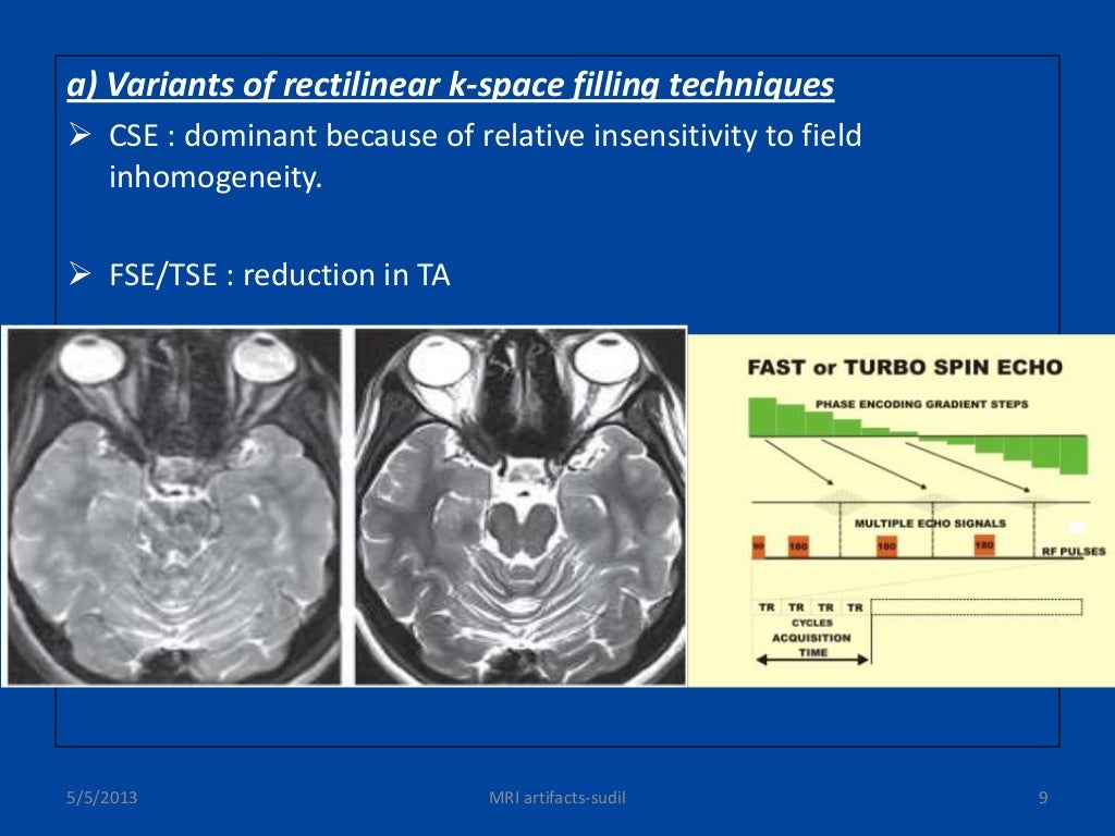 MRI artifacts