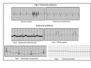 ARTIFACTS IN ECG.pptx