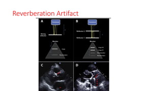 Reverberation Artifact
 