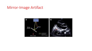 Mirror-Image Artifact
 