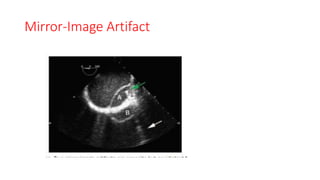 Mirror-Image Artifact
 