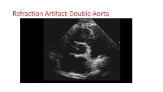 Refraction Artifact-Double Aorta
 
