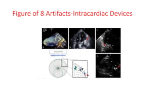 Figure of 8 Artifacts-Intracardiac Devices
 