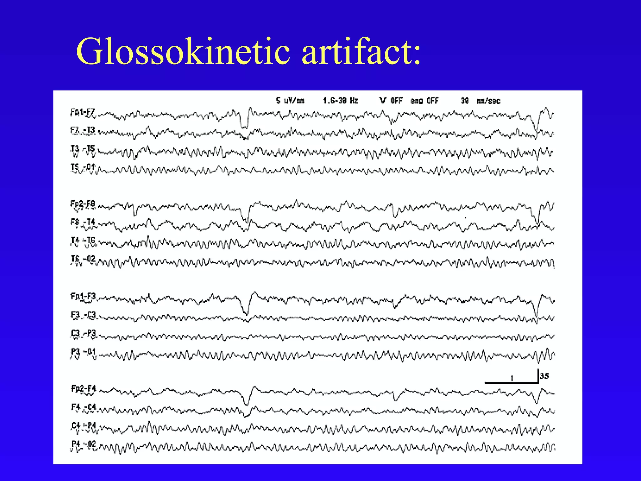 Artifacts in eeg final | PPT