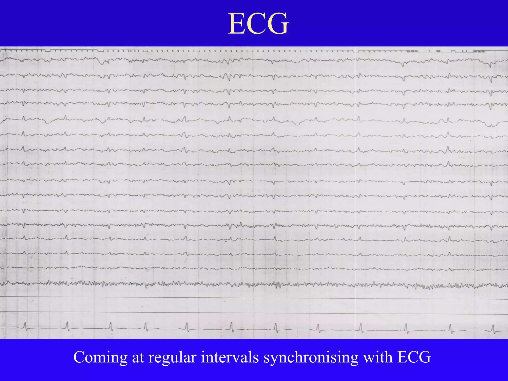 Artifacts in eeg final | PPT