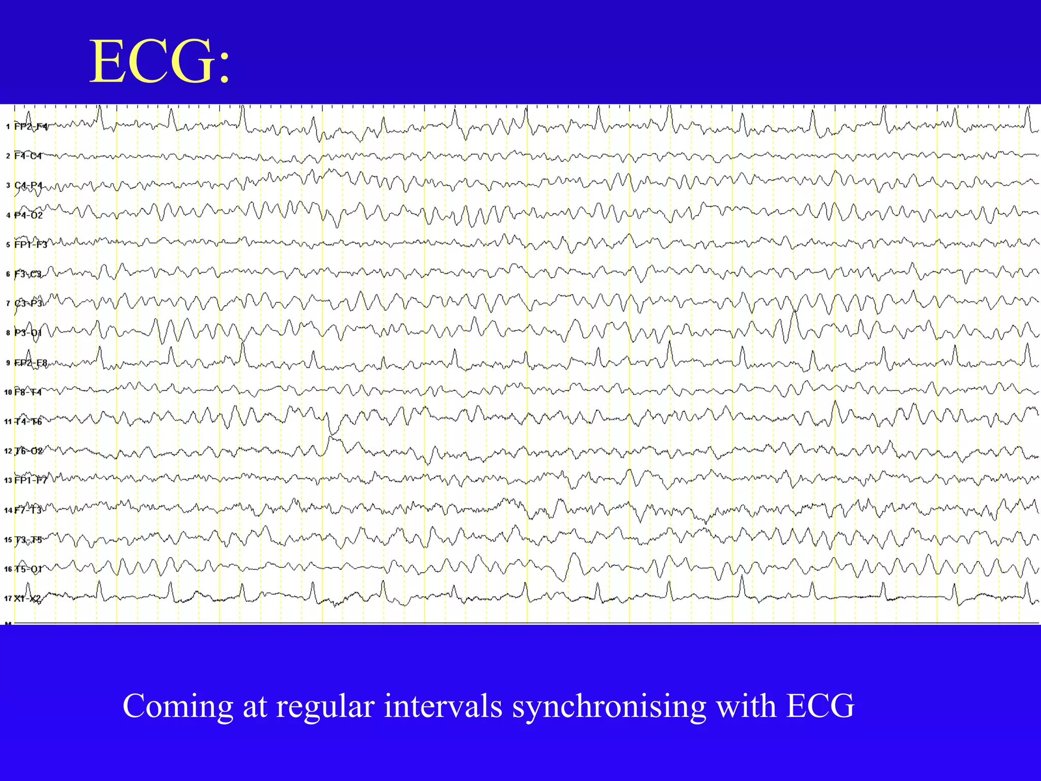 Artifacts in eeg final | PPT