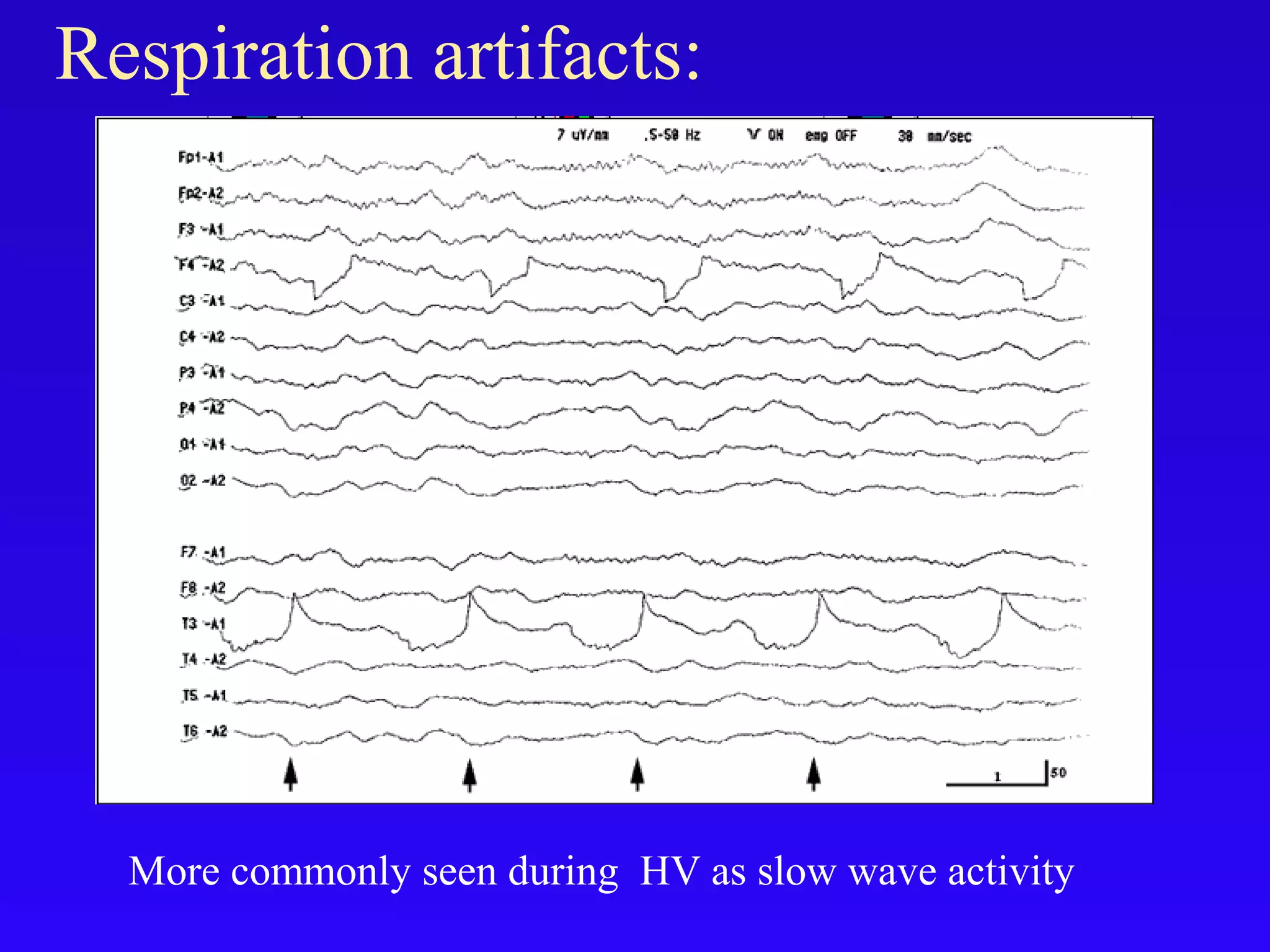 Artifacts in eeg final | PPT