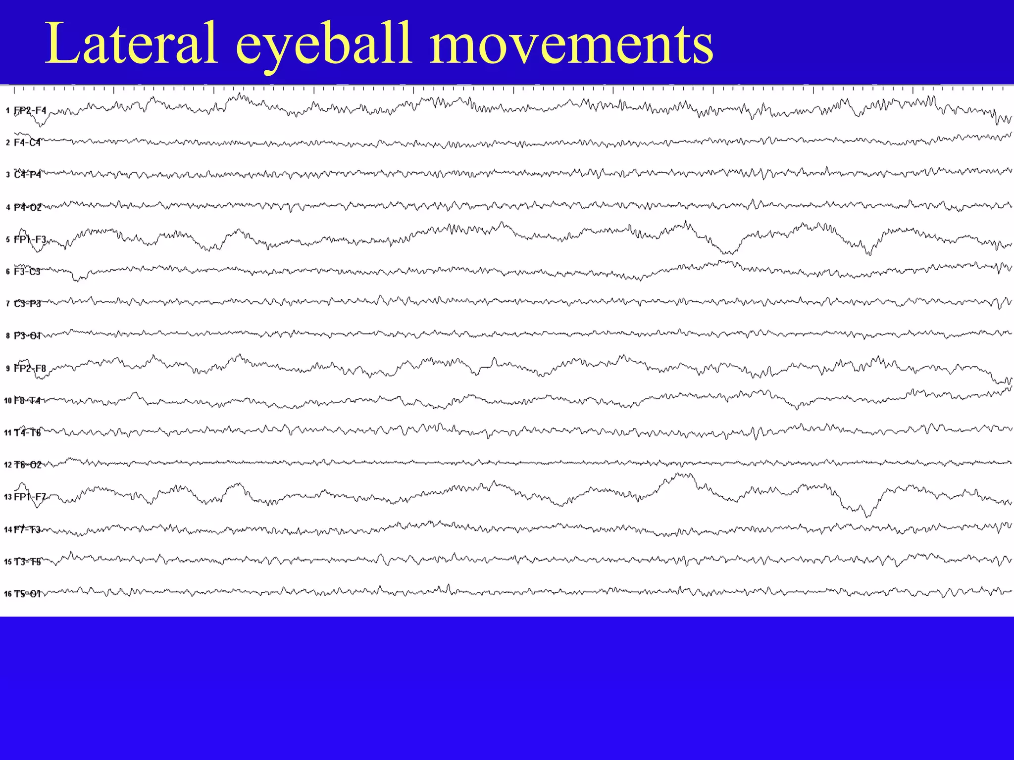 Artifacts in eeg final | PPT