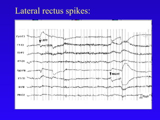 Lateral rectus spikes:
 