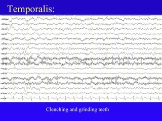 Temporalis:
Clenching and grinding teeth
 