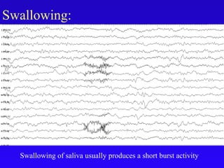 Swallowing:
Swallowing of saliva usually produces a short burst activity
 