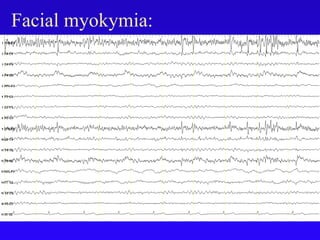 Facial myokymia:
 