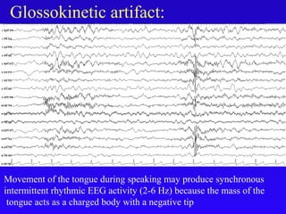 Glossokinetic artifact:
Movement of the tongue during speaking may produce synchronous
intermittent rhythmic EEG activity (2-6 Hz) because the mass of the
tongue acts as a charged body with a negative tip
 