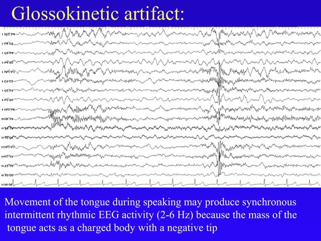Artifacts in eeg final | PPT | Brain and Nervous System Disorders ...