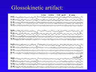Glossokinetic artifact:
 