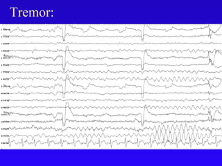 Tremor:
 