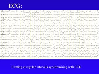 ECG:
Coming at regular intervals synchronising with ECG
 