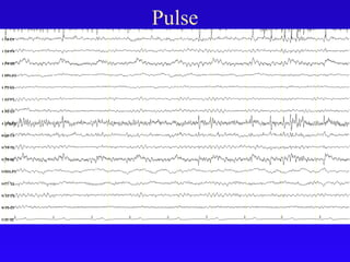 Pulse
 