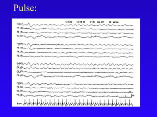 Pulse:
 