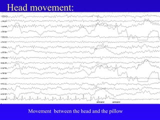 Head movement:
Movement between the head and the pillow
 