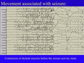 Movement associated with seizure:
Contraction of skeletal muscles before the seizure activity starts
 