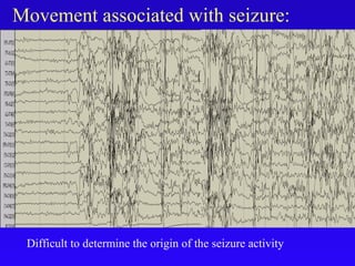 Movement associated with seizure:
Difficult to determine the origin of the seizure activity
 