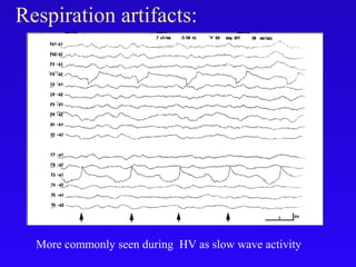 Respiration artifacts:
More commonly seen during HV as slow wave activity
 