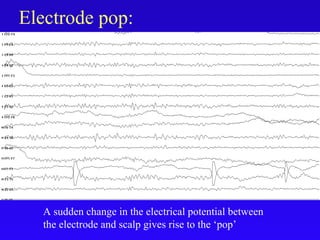 Electrode pop:
A sudden change in the electrical potential between
the electrode and scalp gives rise to the ‘pop’
 