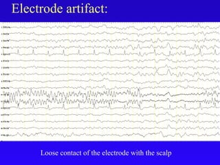 Electrode artifact:
Loose contact of the electrode with the scalp
 
