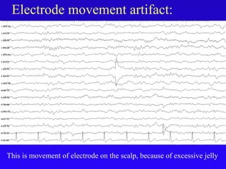 Electrode movement artifact:
This is movement of electrode on the scalp, because of excessive jelly
 