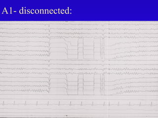 A1- disconnected:
 
