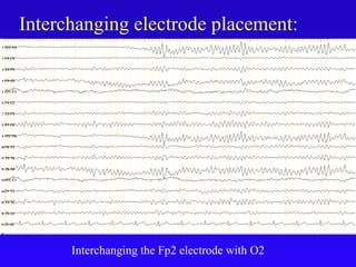 Interchanging electrode placement:
Interchanging the Fp2 electrode with O2
 