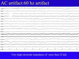 AC artifact:60 hz artifact
Very high electrode impedance of more than 25 kΩ
 