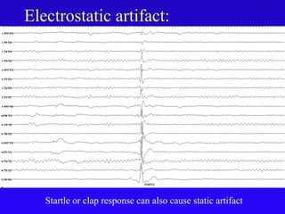 Electrostatic artifact:
Startle or clap response can also cause static artifact
 