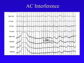 AC Interference
 
