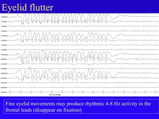 Eyelid flutter
Fine eyelid movements may produce rhythmic 4-8 Hz activity in the
frontal leads (disappear on fixation)
 