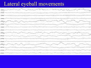 Lateral eyeball movements
 