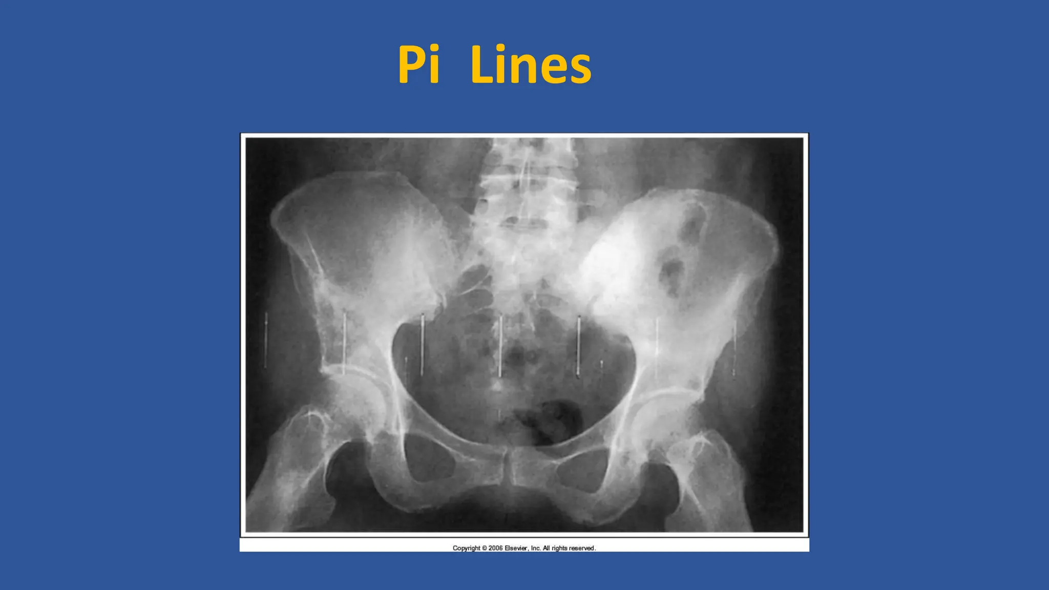 Pi Line Pattern ARTIFACTS IN GENERAL radiography for radiodept.pptx