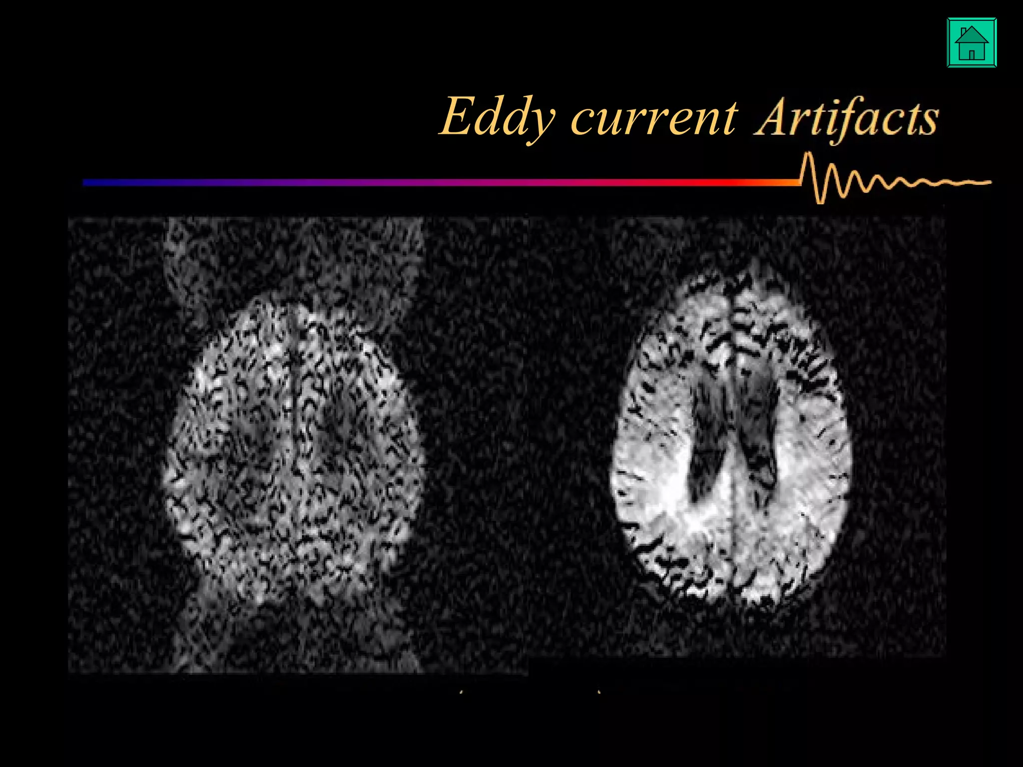 Artifacts in MRI | PPT | Chemistry | Science
