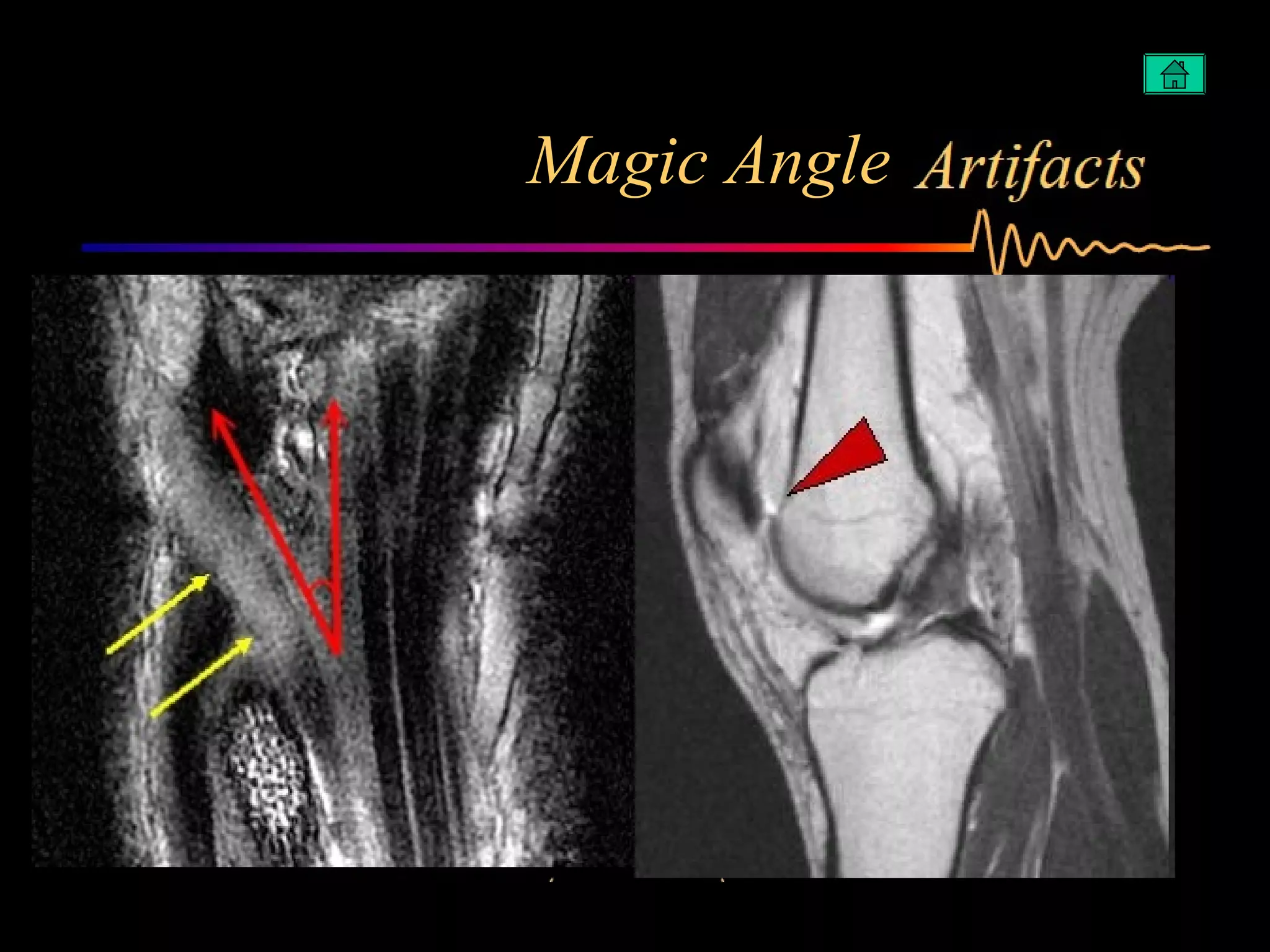 Artifacts in MRI | PPT