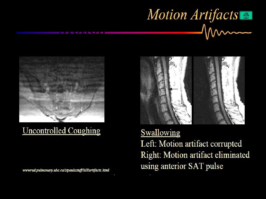 Artifacts in MRI