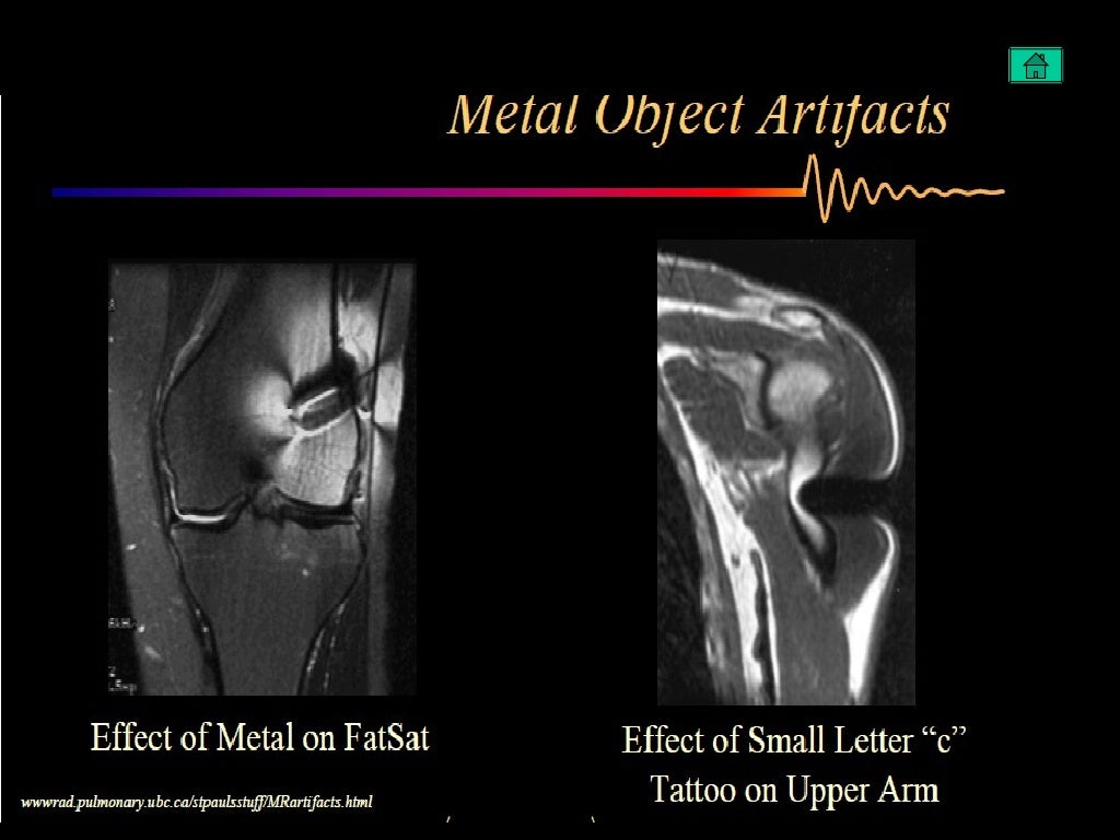 Artifacts in MRI