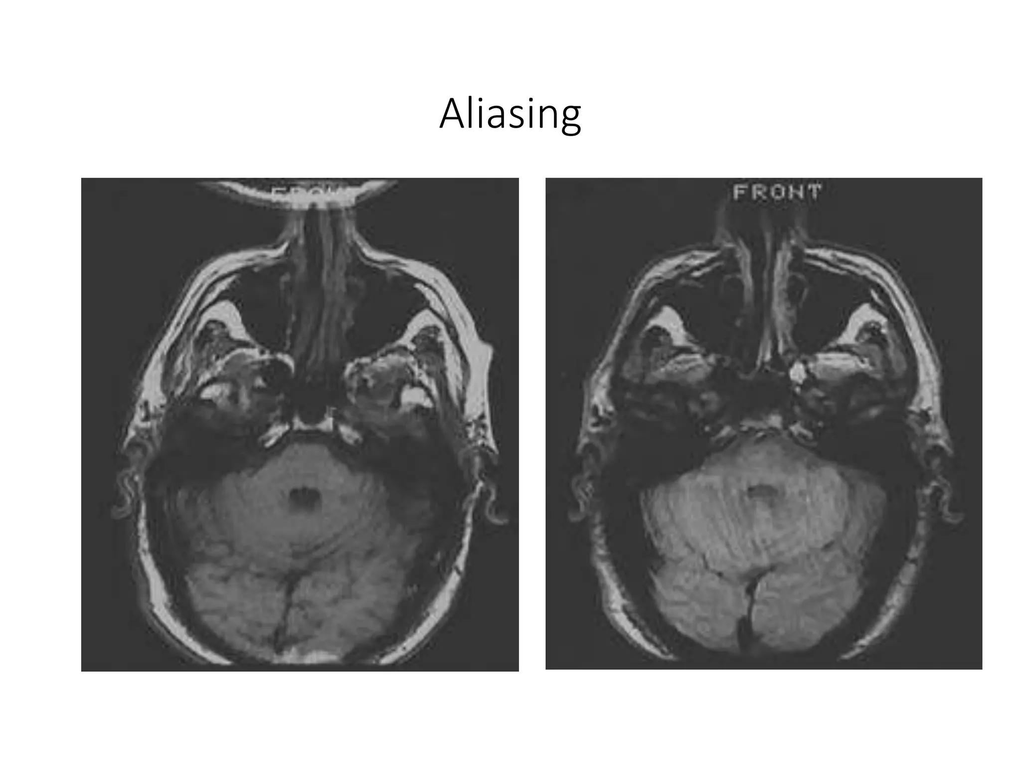 MRI Artifacts (introduction, classification, types) | PPT